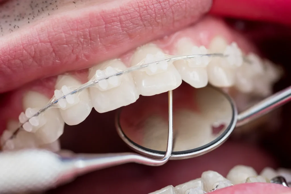 dentist checking up teeth with ceramic brackets us 2025 01 16 23 18 20 utc