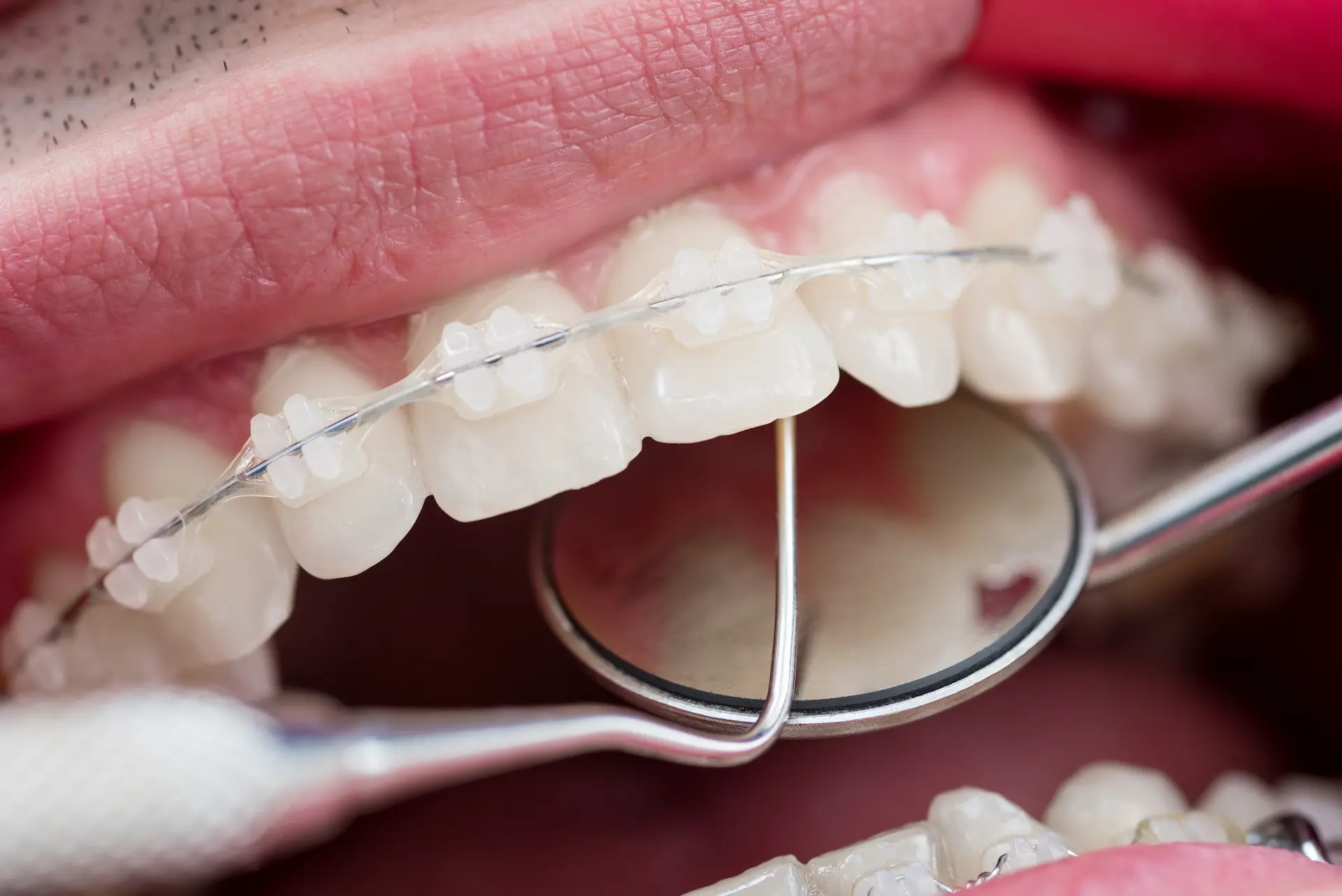 dentist checking up teeth with ceramic brackets us 2025 01 16 23 18 20 utc